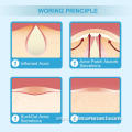 Acne Pimple Patch Hydrocolloid Acne Spot Dressing Sticks